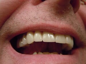 dentures